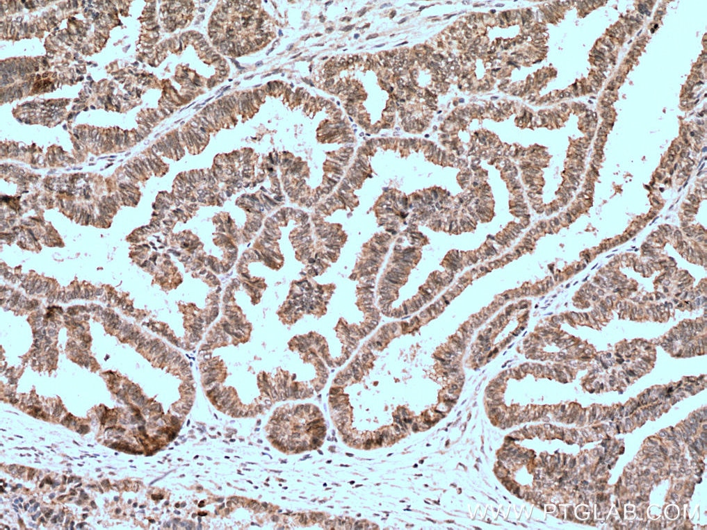 Immunohistochemistry (IHC) staining of human ovary tumor tissue using BAP1 Polyclonal antibody (10398-1-AP)