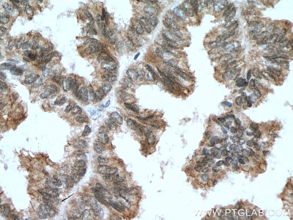 Immunohistochemistry (IHC) staining of human ovary tumor tissue using BAP1 Polyclonal antibody (10398-1-AP)