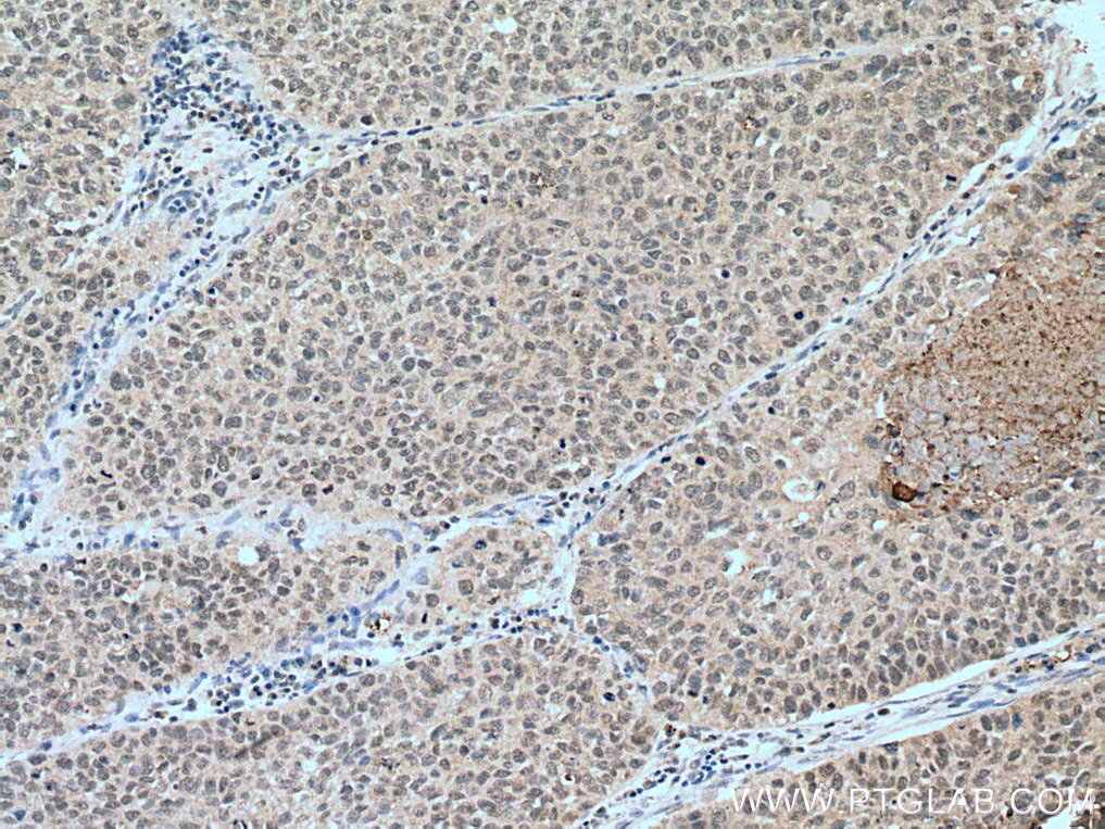 Immunohistochemistry (IHC) staining of human lung cancer tissue using BAP1 Polyclonal antibody (10398-1-AP)