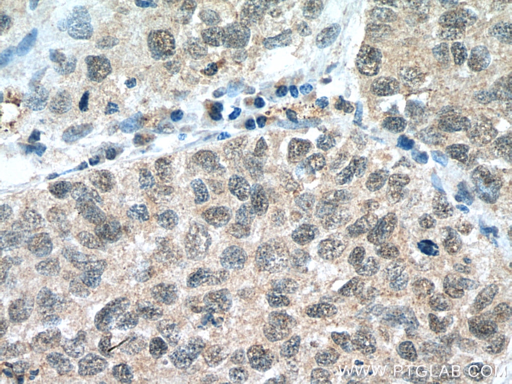 Immunohistochemistry (IHC) staining of human lung cancer tissue using BAP1 Polyclonal antibody (10398-1-AP)
