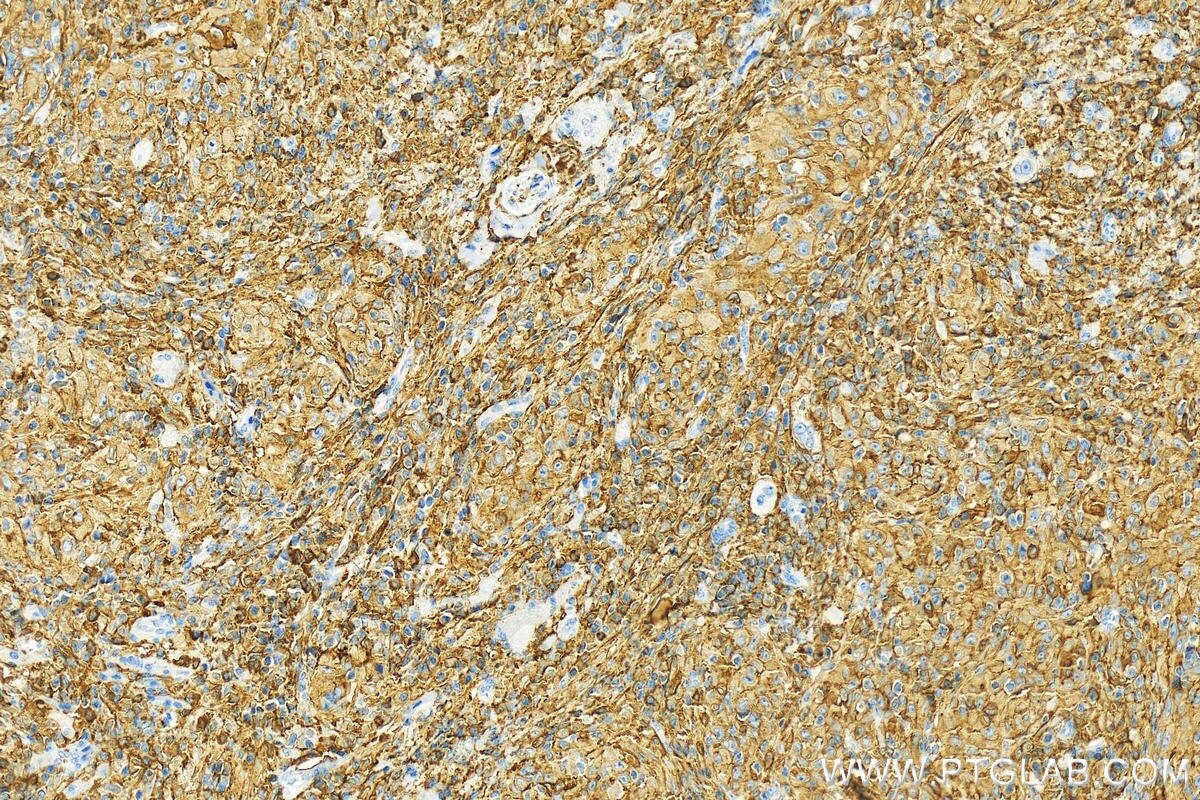 Immunohistochemistry (IHC) staining of human skin cancer tissue using BASP1 Polyclonal antibody (14880-1-AP)