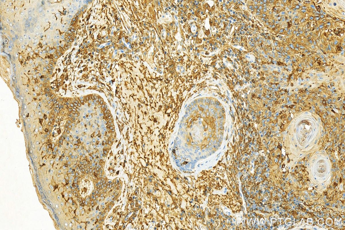 Immunohistochemistry (IHC) staining of human skin cancer tissue using BASP1 Polyclonal antibody (14880-1-AP)