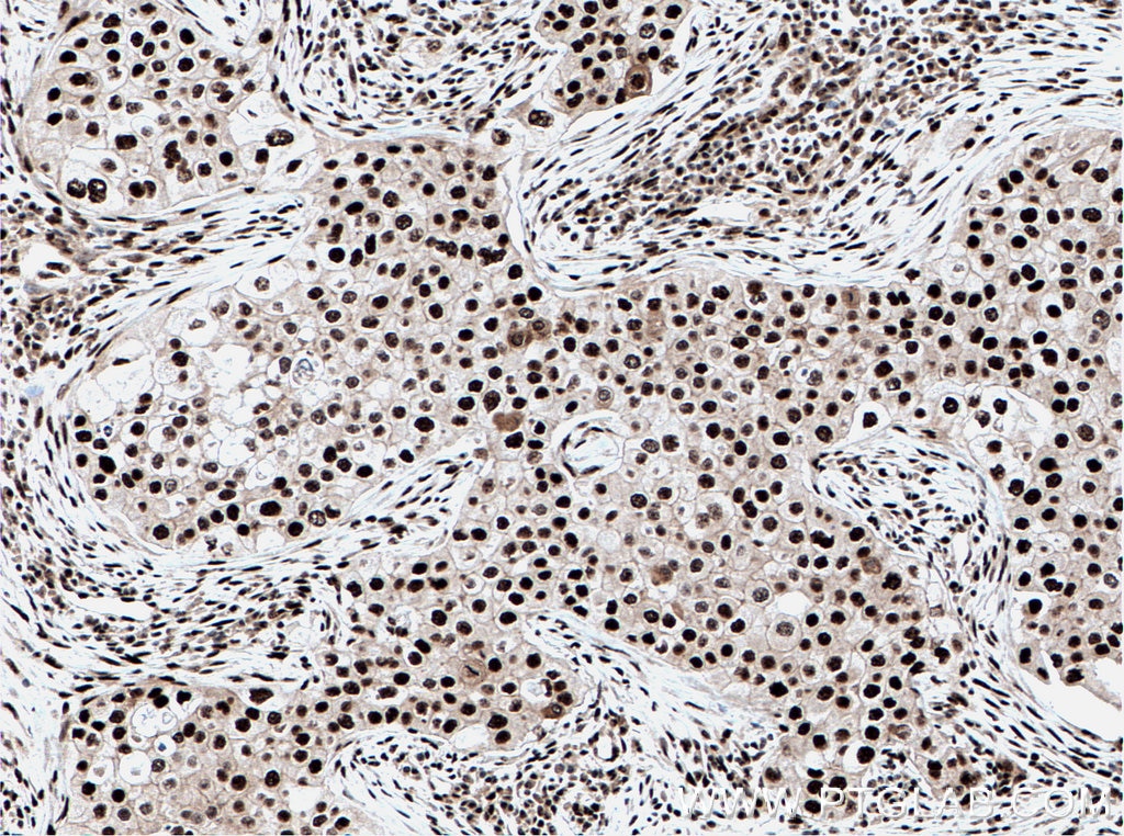 Immunohistochemistry (IHC) staining of human breast cancer tissue using DDX39B Polyclonal antibody (14798-1-AP)