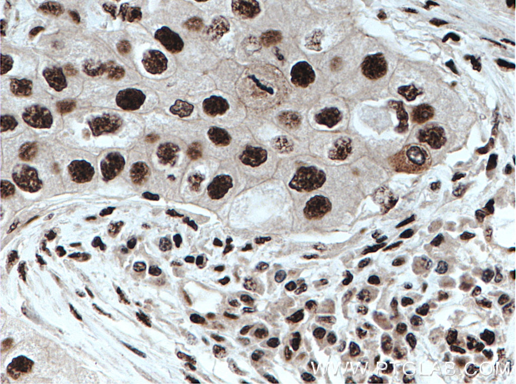 Immunohistochemistry (IHC) staining of human breast cancer tissue using DDX39B Polyclonal antibody (14798-1-AP)