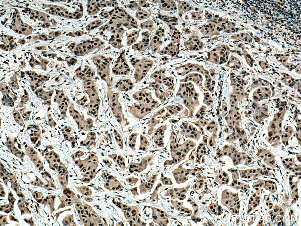 Immunohistochemistry (IHC) staining of human breast cancer tissue using BAT1 Monoclonal antibody (67641-1-Ig)