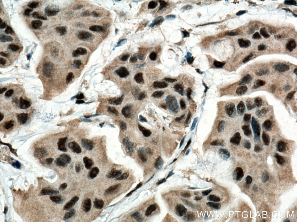 Immunohistochemistry (IHC) staining of human breast cancer tissue using BAT1 Monoclonal antibody (67641-1-Ig)
