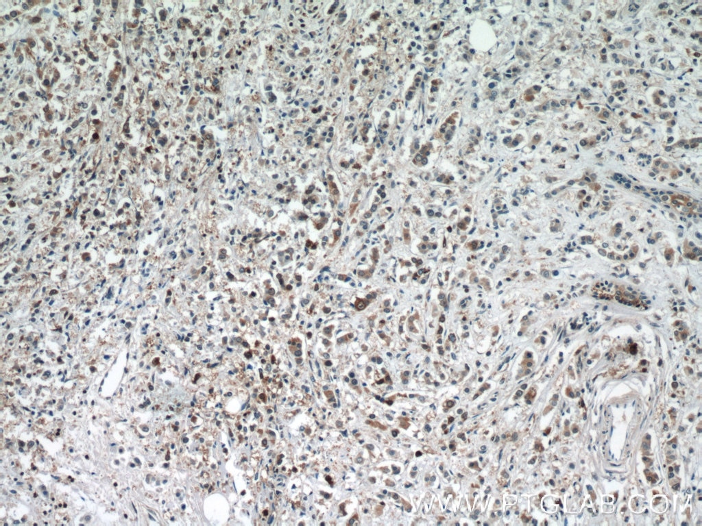 Immunohistochemistry (IHC) staining of human breast cancer tissue using BAX Polyclonal antibody (23931-1-AP)