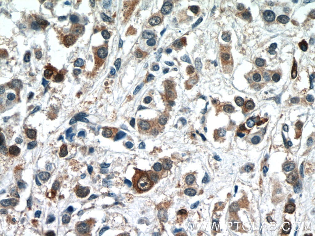 Immunohistochemistry (IHC) staining of human breast cancer tissue using BAX Polyclonal antibody (23931-1-AP)