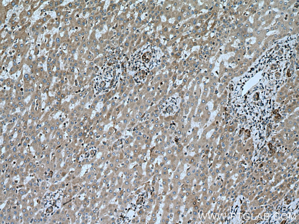 Immunohistochemistry (IHC) staining of human liver cancer tissue using BAX Monoclonal antibody (60267-1-Ig)
