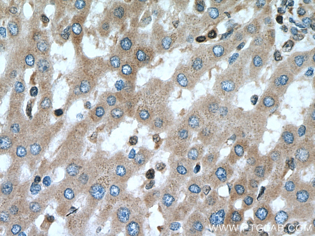 Immunohistochemistry (IHC) staining of human liver cancer tissue using BAX Monoclonal antibody (60267-1-Ig)