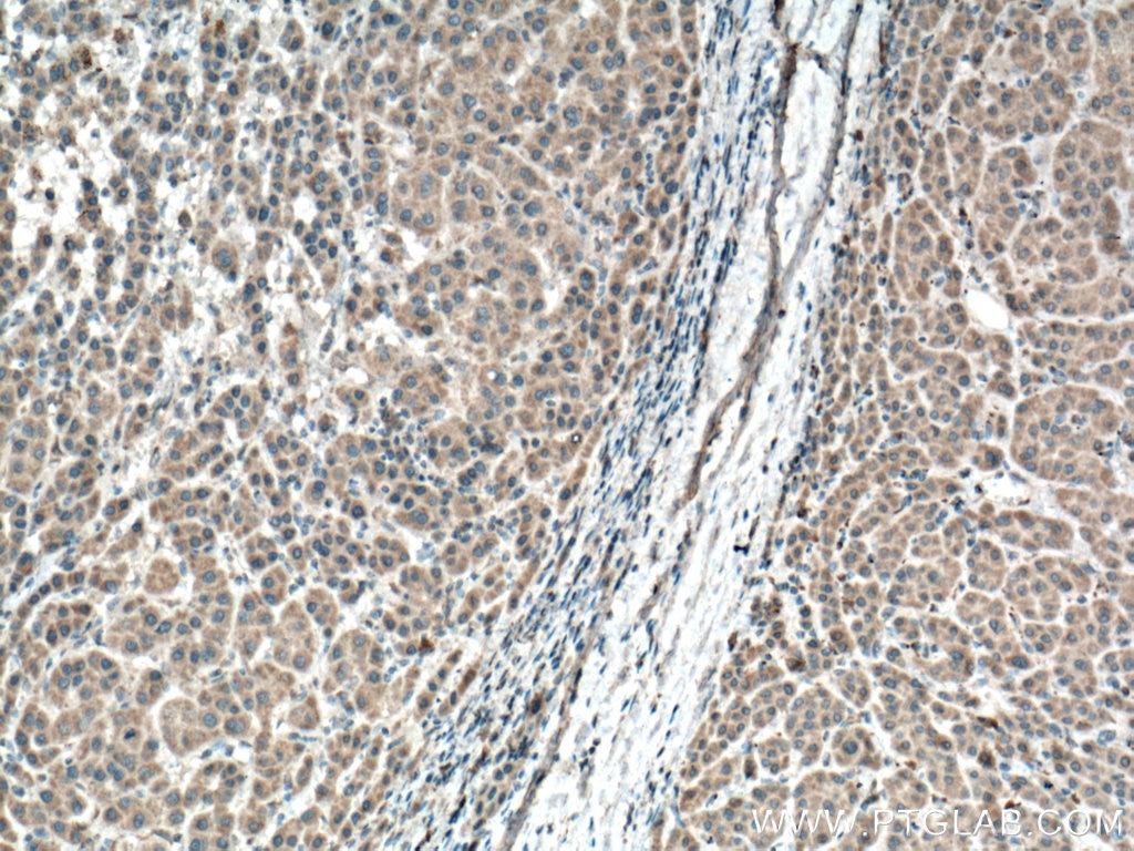 Immunohistochemistry (IHC) staining of human liver cancer tissue using BBS10 Monoclonal antibody (66679-1-Ig)