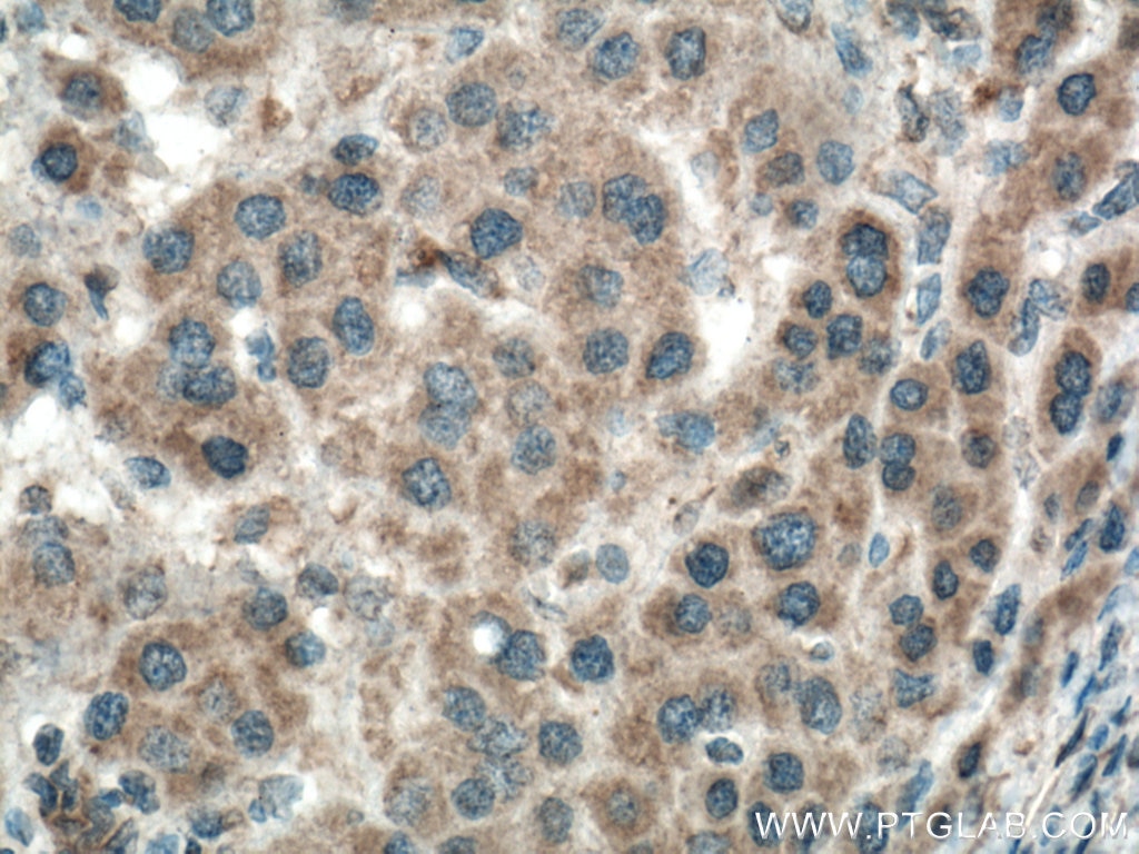 Immunohistochemistry (IHC) staining of human liver cancer tissue using BBS10 Monoclonal antibody (66679-1-Ig)