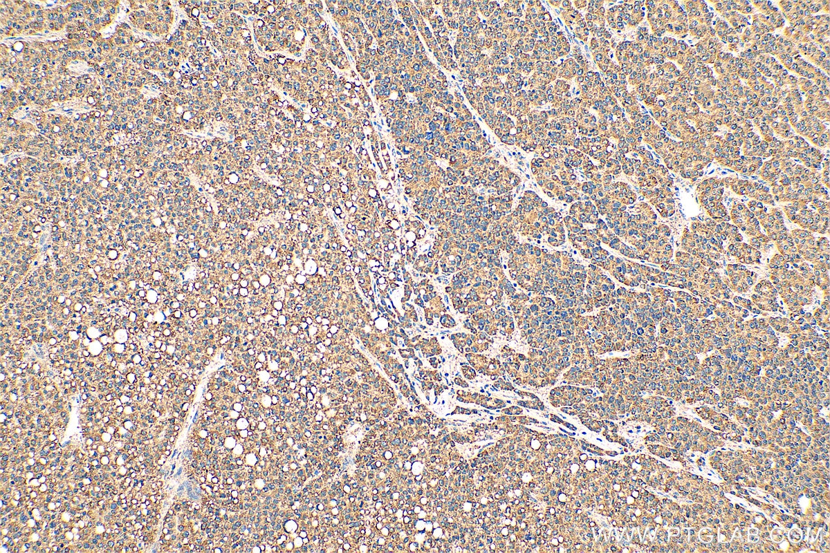 Immunohistochemistry (IHC) staining of human liver cancer tissue using MKS1 Polyclonal antibody (16206-1-AP)