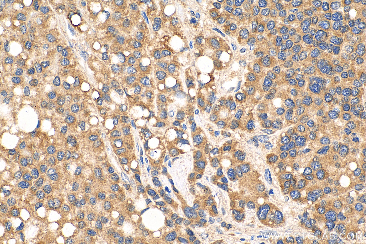 Immunohistochemistry (IHC) staining of human liver cancer tissue using MKS1 Polyclonal antibody (16206-1-AP)