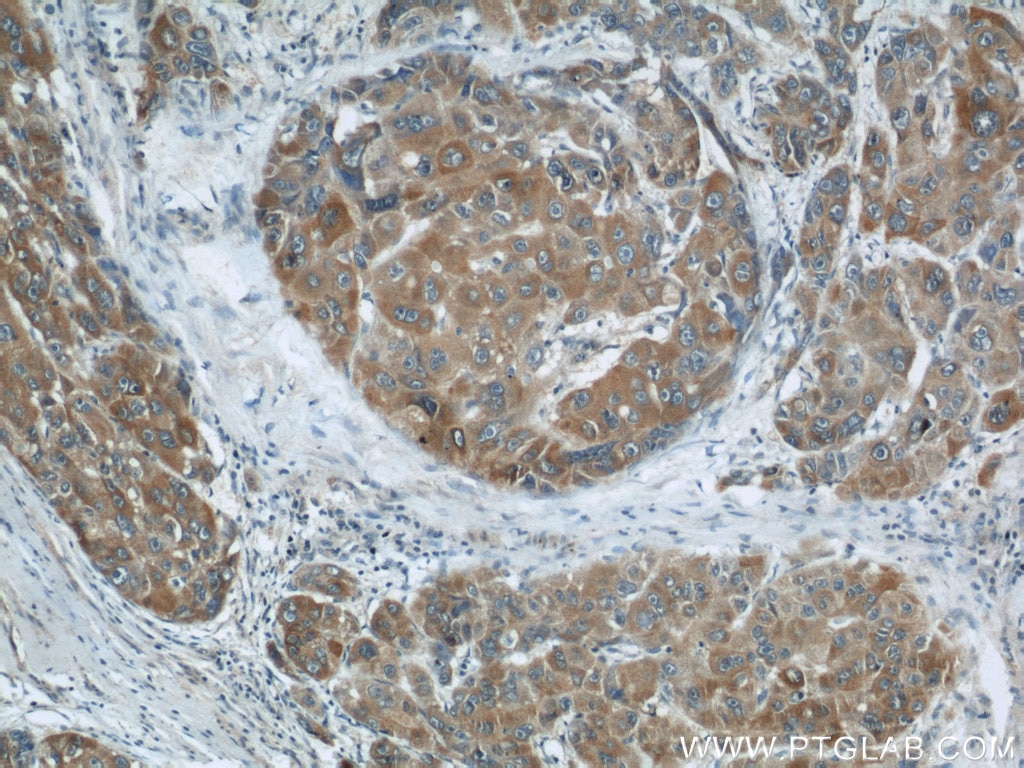 Immunohistochemistry (IHC) staining of human liver cancer tissue using MKS1 Polyclonal antibody (16206-1-AP)