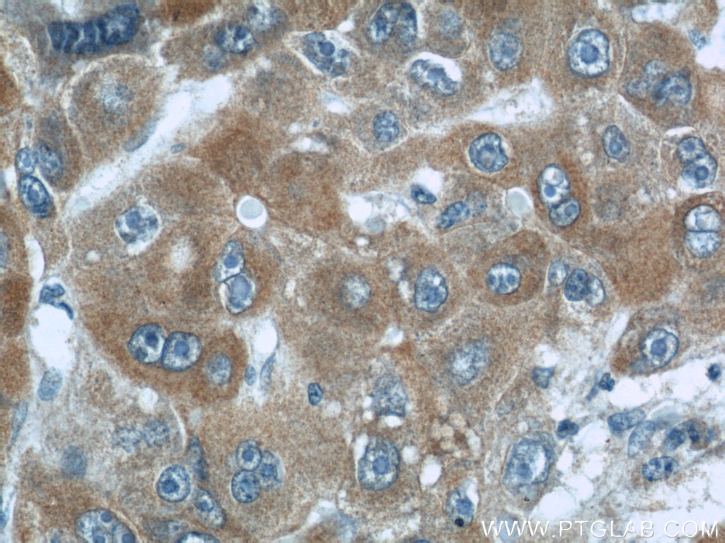 Immunohistochemistry (IHC) staining of human liver cancer tissue using MKS1 Polyclonal antibody (16206-1-AP)