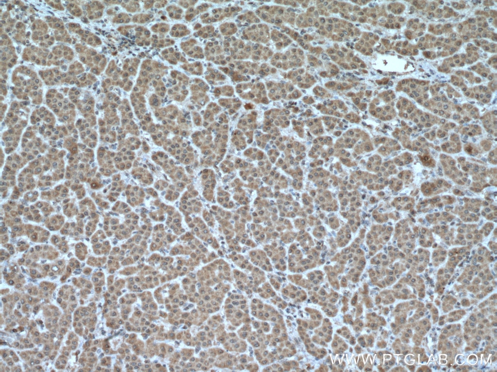 IHC staining of human liver cancer using 66518-1-Ig