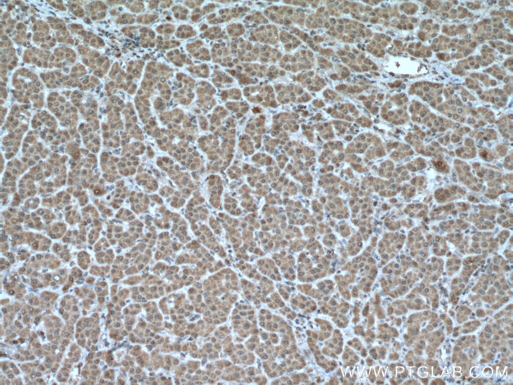 Immunohistochemistry (IHC) staining of human liver cancer tissue using MKS1 Monoclonal antibody (66518-1-Ig)