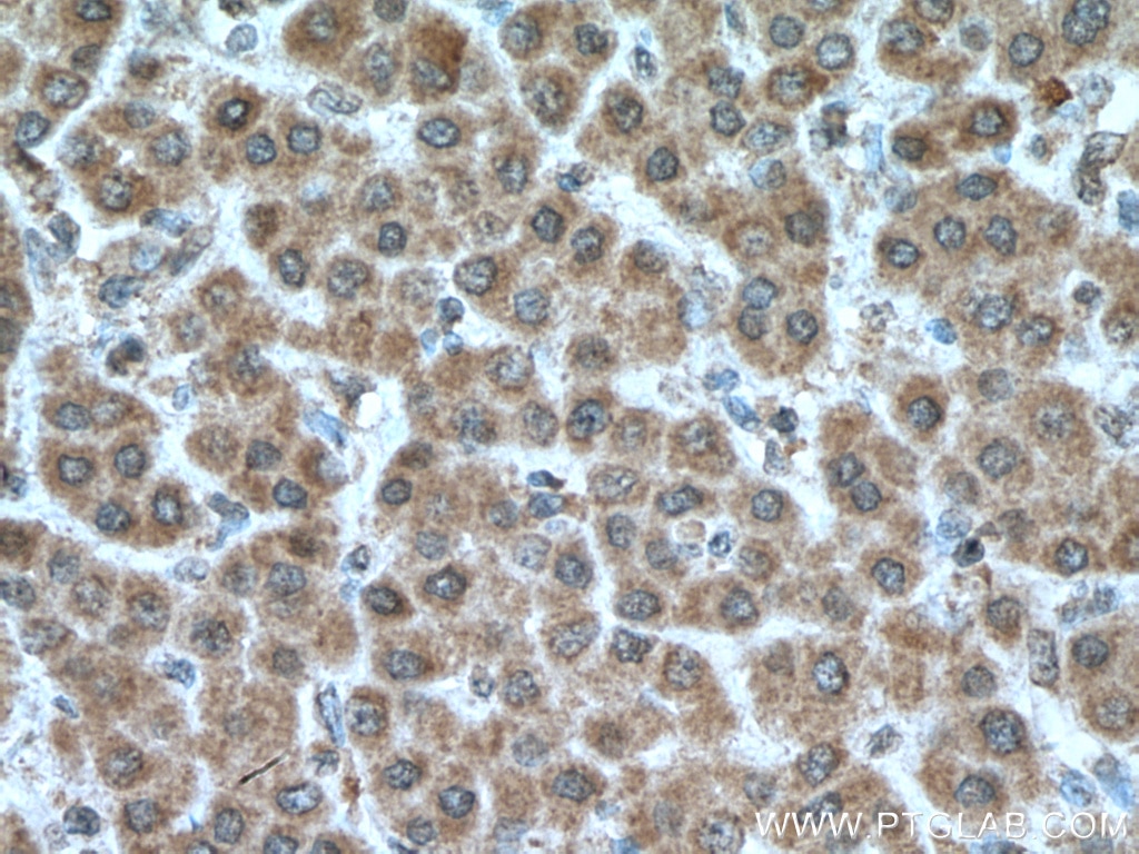 IHC staining of human liver cancer using 66518-1-Ig