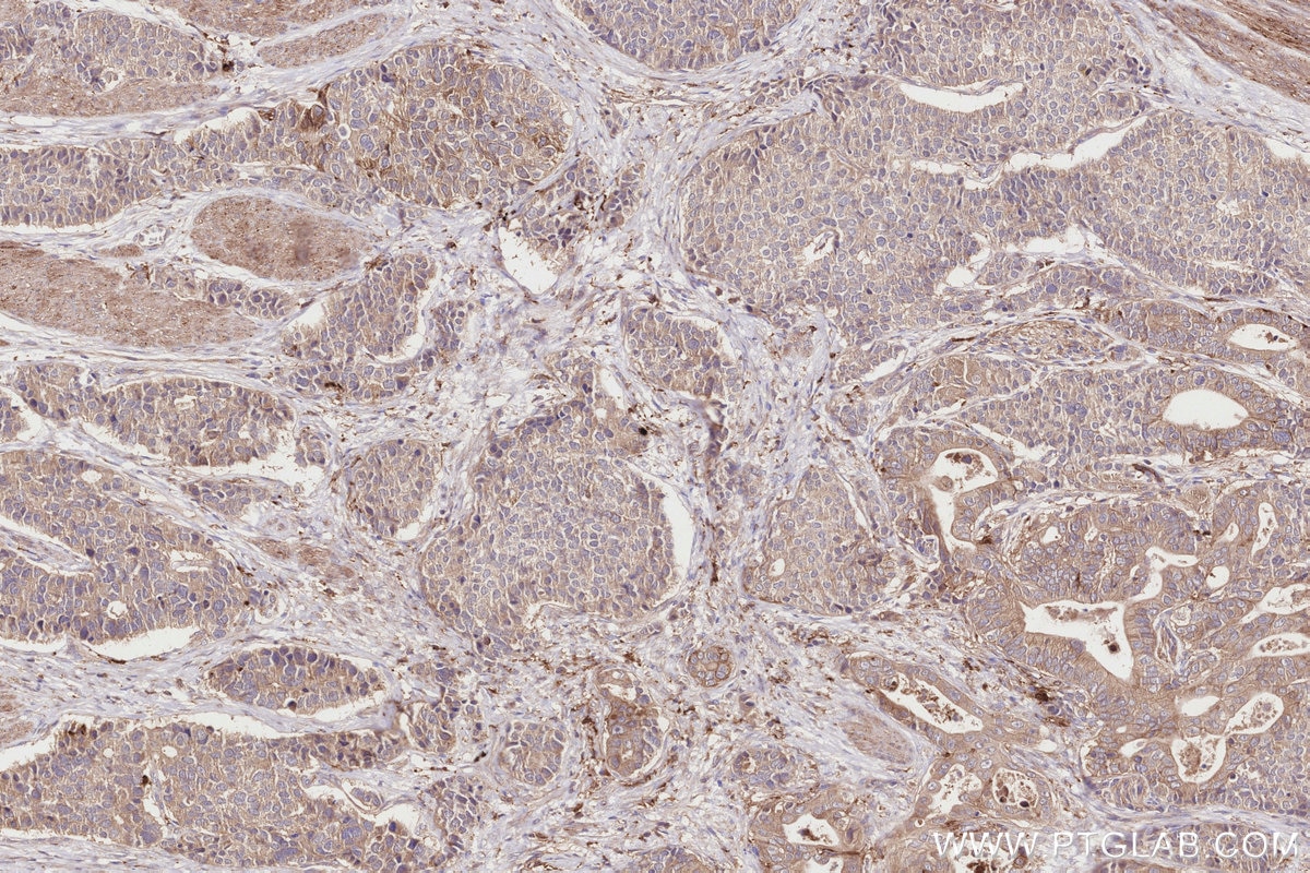 Immunohistochemistry (IHC) staining of human stomach cancer tissue using BBS4 Recombinant monoclonal antibody (82961-1-RR)