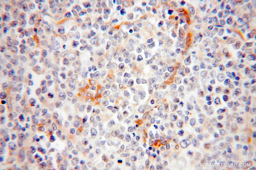 Immunohistochemistry (IHC) staining of human lymphoma tissue using BAP29 Polyclonal antibody (15796-1-AP)