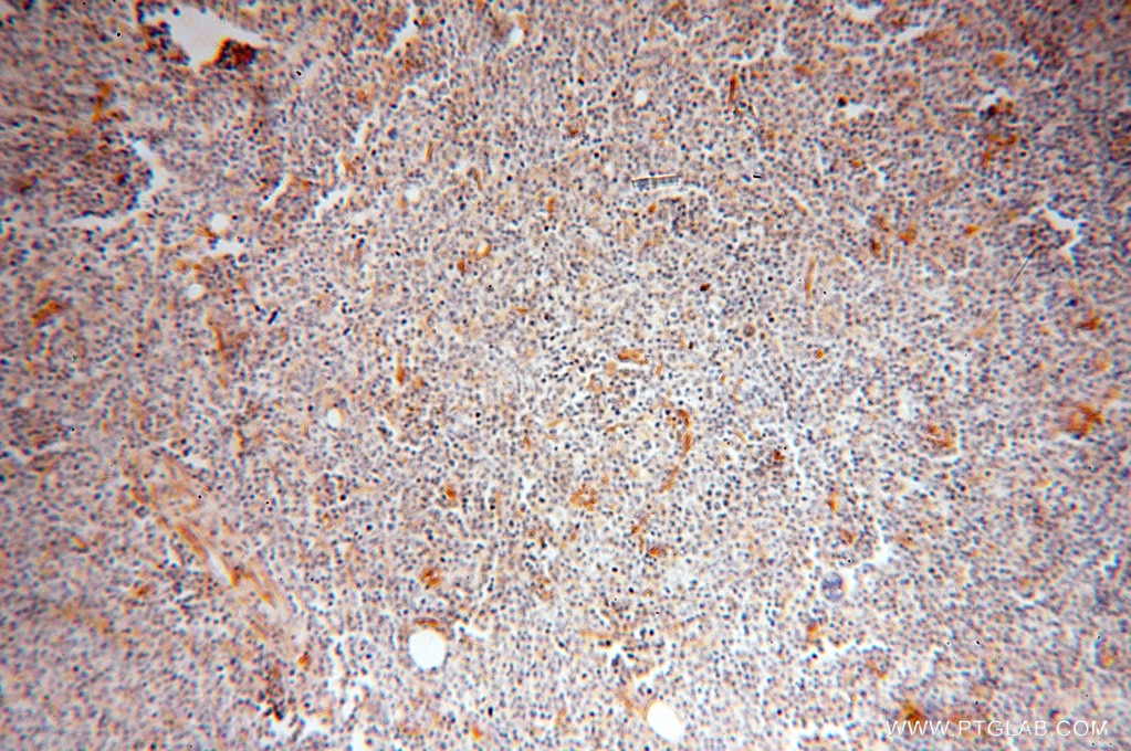 Immunohistochemistry (IHC) staining of human lymphoma tissue using BAP29 Polyclonal antibody (15796-1-AP)