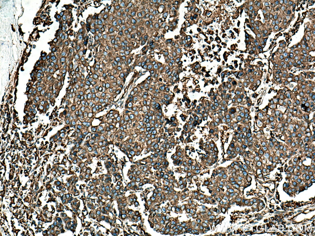 Immunohistochemistry (IHC) staining of human breast cancer tissue using BAP31 Polyclonal antibody (11200-1-AP)