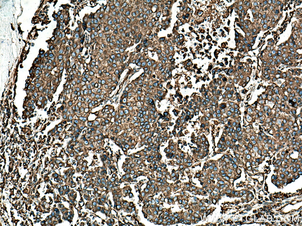 IHC staining of human breast cancer using 11200-1-AP