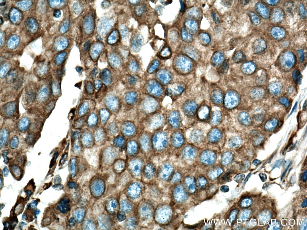 IHC staining of human breast cancer using 11200-1-AP