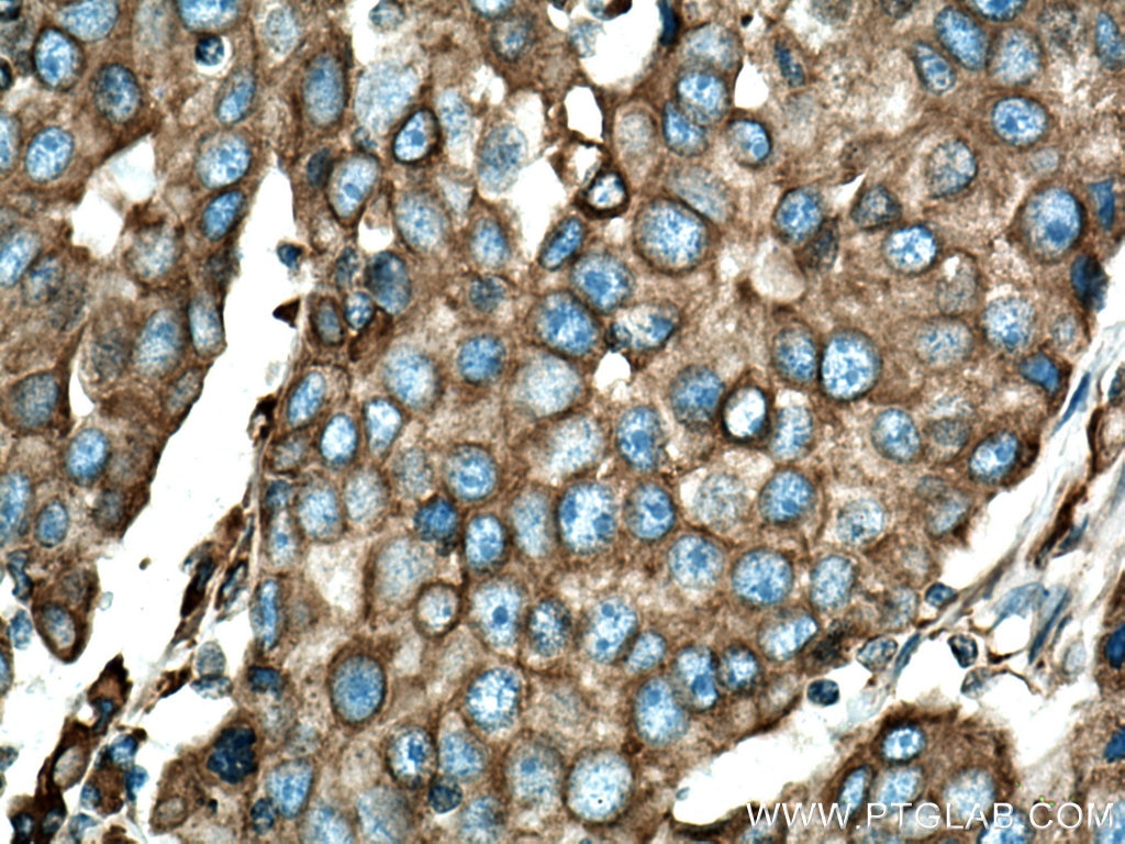 Immunohistochemistry (IHC) staining of human breast cancer tissue using BAP31 Polyclonal antibody (11200-1-AP)