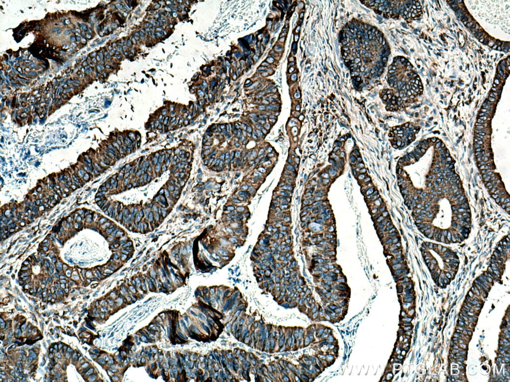 Immunohistochemistry (IHC) staining of human colon cancer tissue using BAP31 Polyclonal antibody (11200-1-AP)