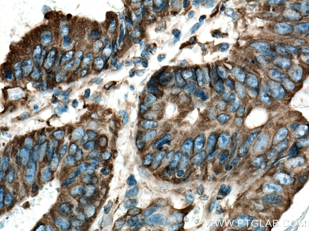 Immunohistochemistry (IHC) staining of human colon cancer tissue using BAP31 Polyclonal antibody (11200-1-AP)