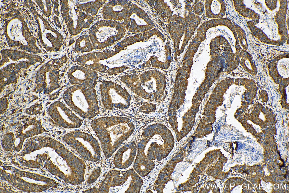 Immunohistochemistry (IHC) staining of human colon cancer tissue using p130Cas / BCAR1 Polyclonal antibody (16815-1-AP)