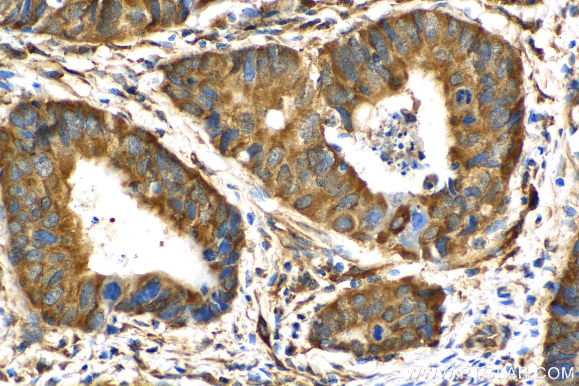 Immunohistochemistry (IHC) staining of human colon cancer tissue using p130Cas / BCAR1 Polyclonal antibody (16815-1-AP)