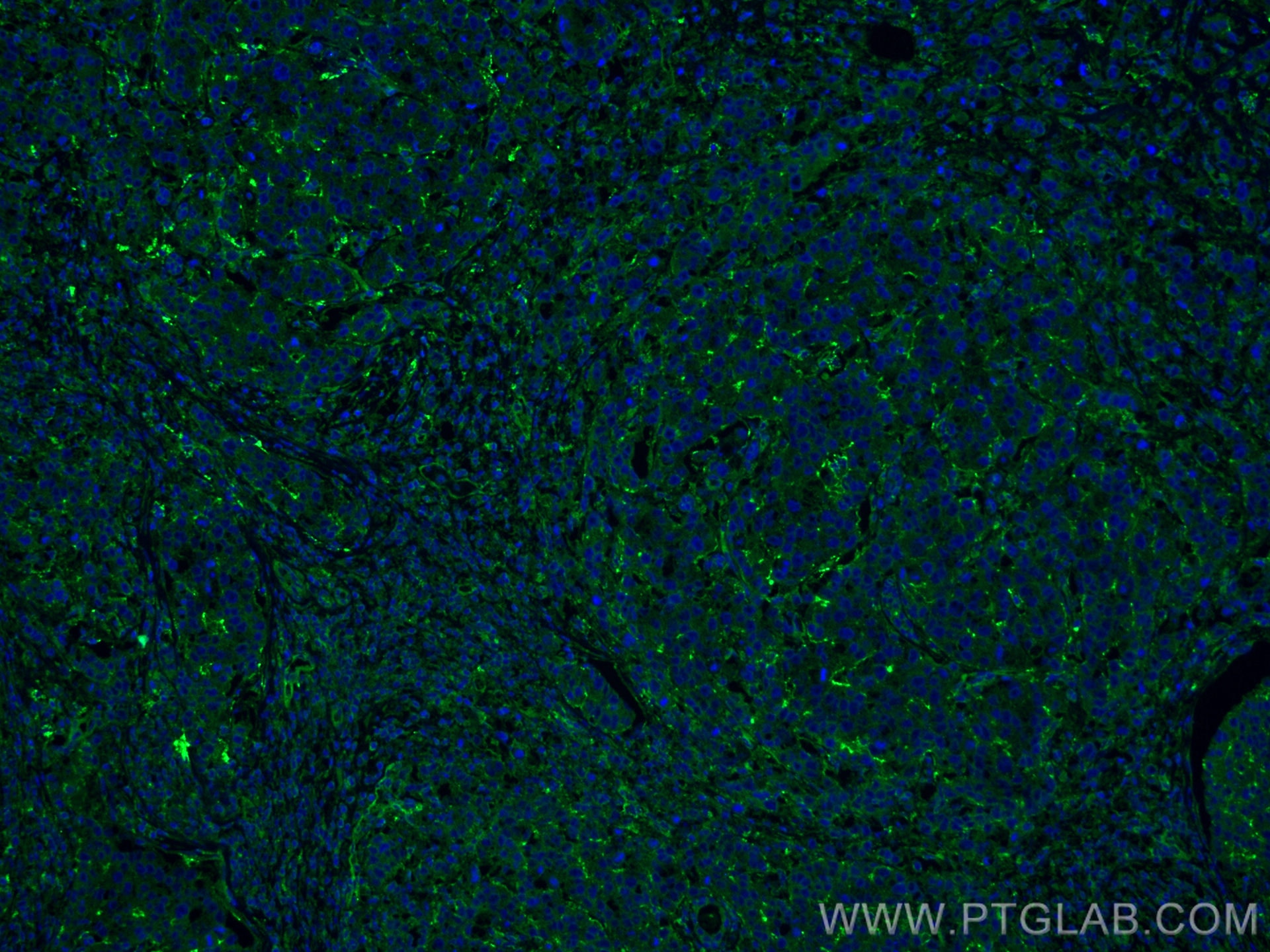 Immunofluorescence (IF) / fluorescent staining of human breast cancer tissue using p130Cas / BCAR1 Monoclonal antibody (67215-1-Ig)