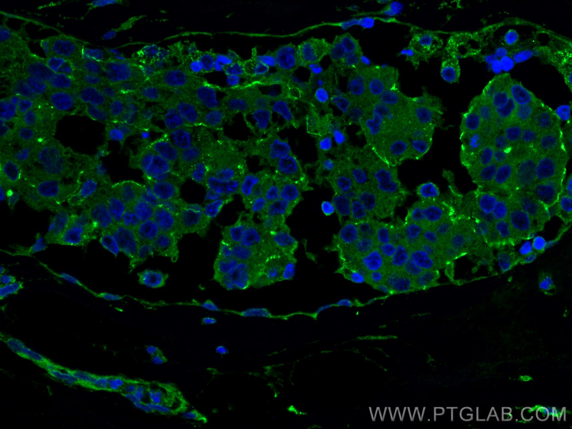 Immunofluorescence (IF) / fluorescent staining of human breast cancer tissue using p130Cas / BCAR1 Monoclonal antibody (67215-1-Ig)