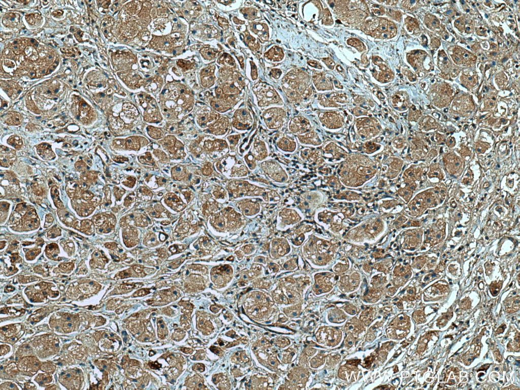 Immunohistochemistry (IHC) staining of human breast cancer tissue using p130Cas / BCAR1 Monoclonal antibody (67215-1-Ig)