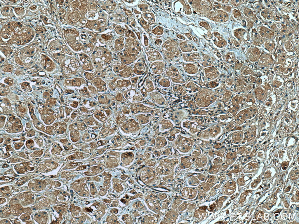 IHC staining of human breast cancer using 67215-1-Ig