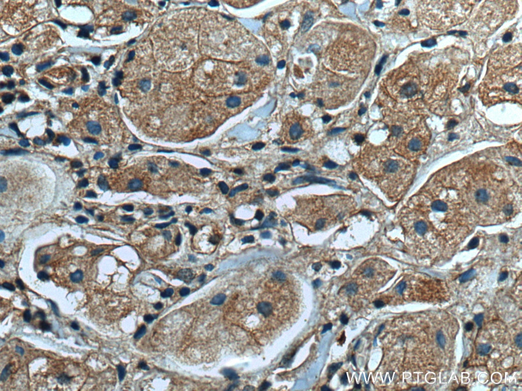 IHC staining of human breast cancer using 67215-1-Ig