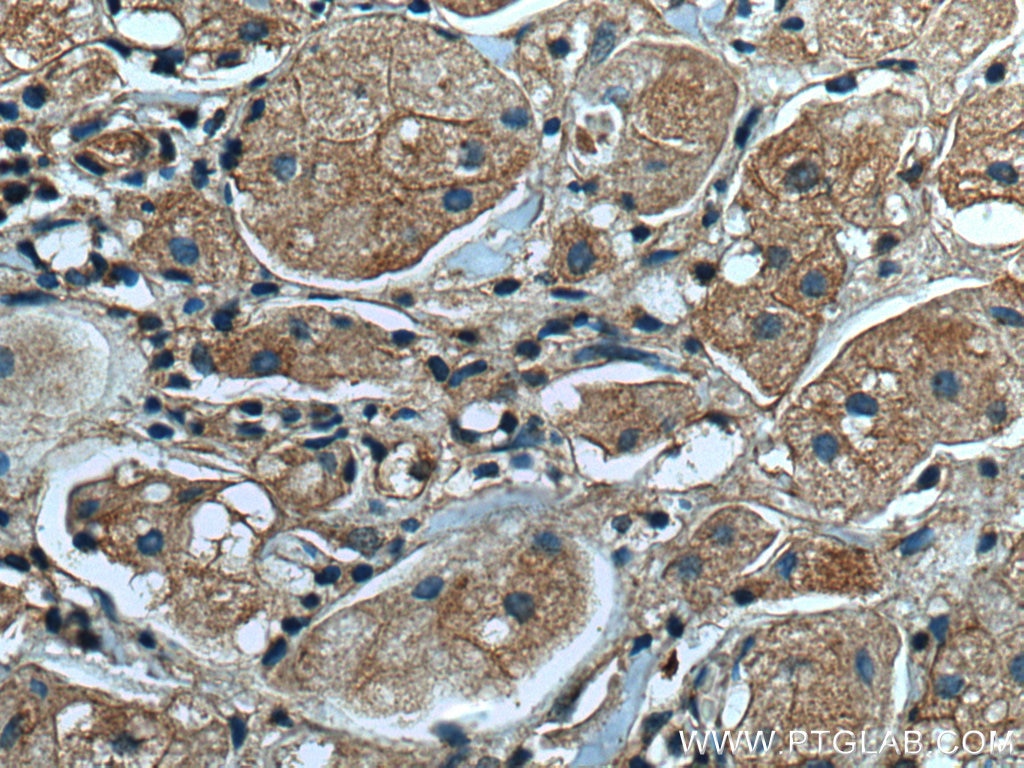 Immunohistochemistry (IHC) staining of human breast cancer tissue using p130Cas / BCAR1 Monoclonal antibody (67215-1-Ig)