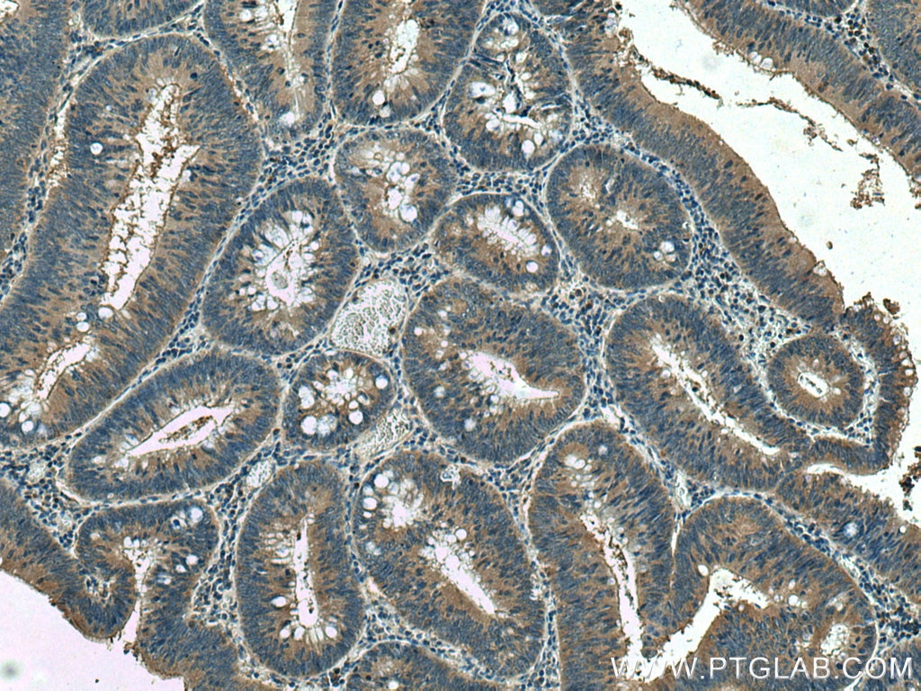 Immunohistochemistry (IHC) staining of human colon cancer tissue using p130Cas / BCAR1 Monoclonal antibody (67215-1-Ig)