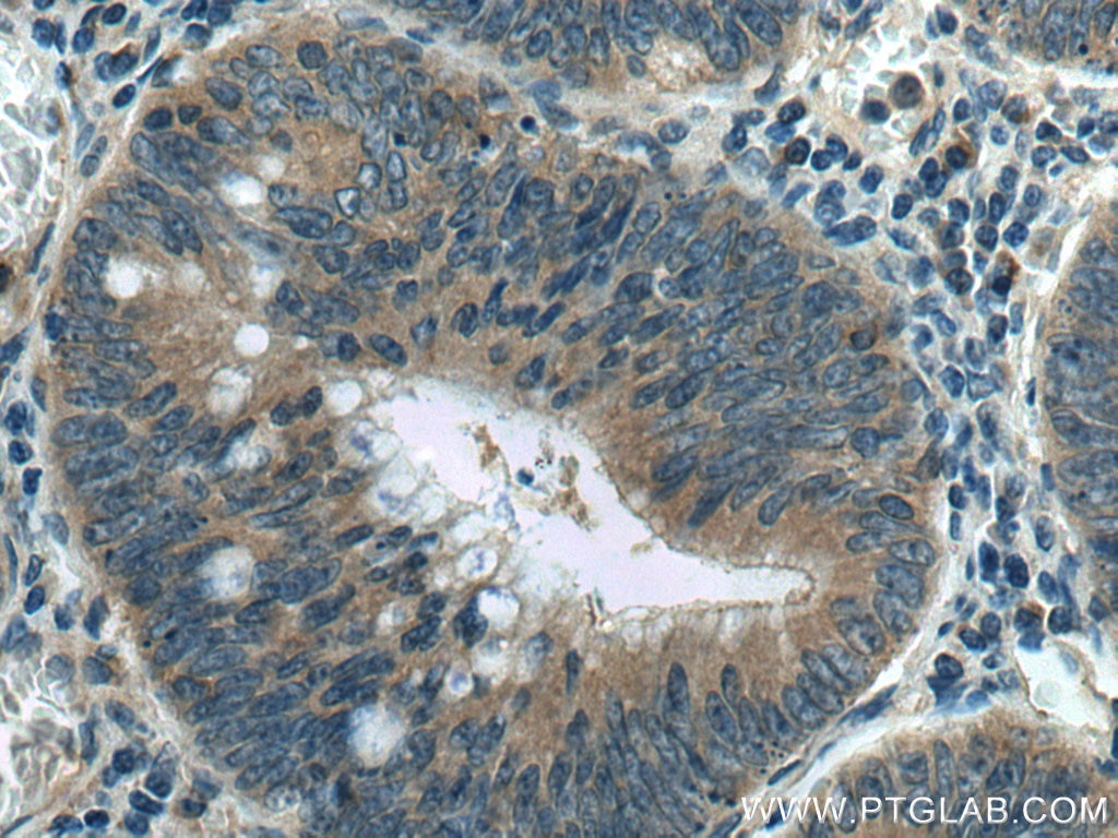 Immunohistochemistry (IHC) staining of human colon cancer tissue using p130Cas / BCAR1 Monoclonal antibody (67215-1-Ig)