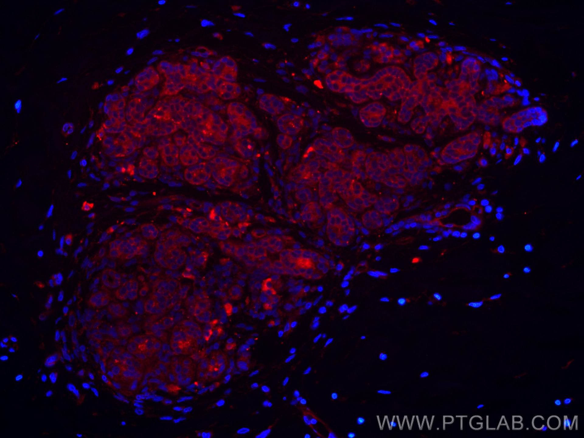 Immunofluorescence (IF) / fluorescent staining of human breast cancer tissue using CoraLite®594-conjugated p130Cas / BCAR1 Monoclonal (CL594-67215)