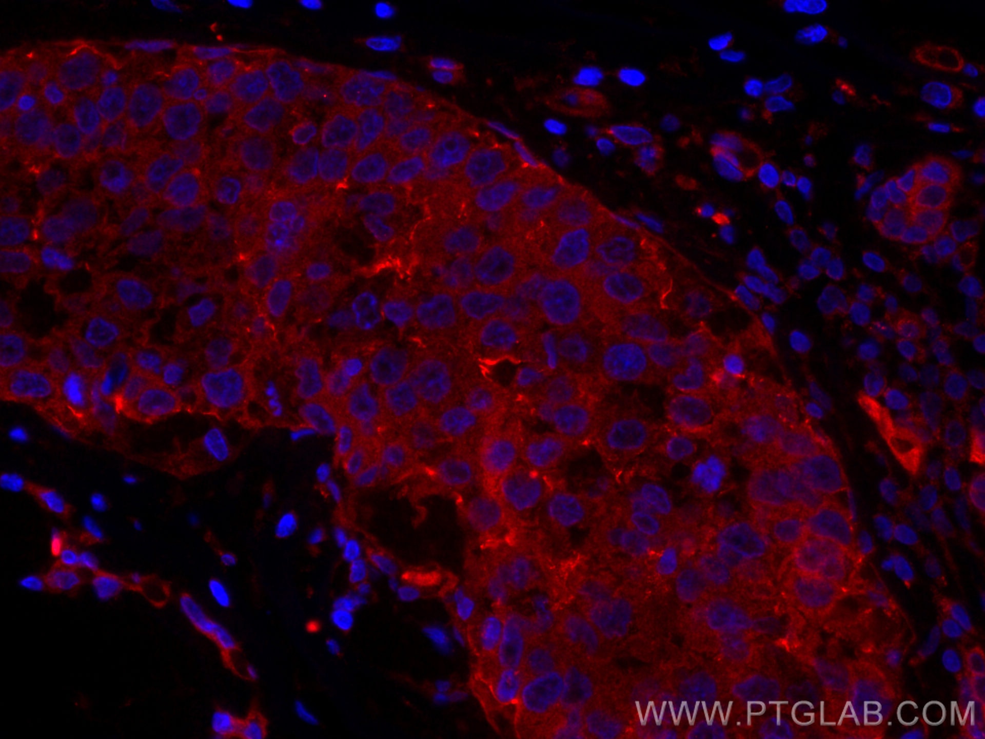 Immunofluorescence (IF) / fluorescent staining of human breast cancer tissue using CoraLite®594-conjugated p130Cas / BCAR1 Monoclonal (CL594-67215)