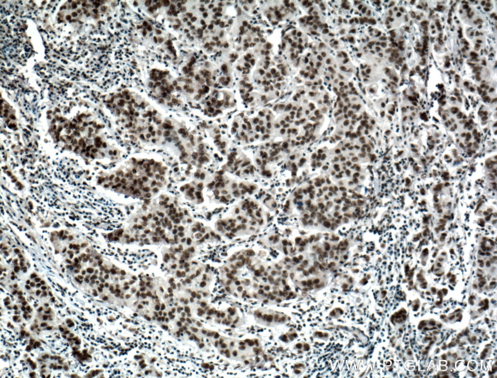 Immunohistochemistry (IHC) staining of human prostate cancer tissue using BCAS2 Polyclonal antibody (10414-1-AP)