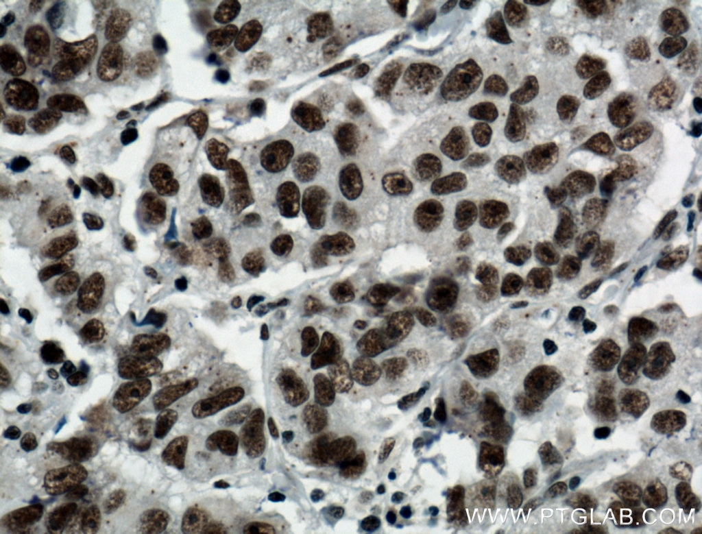 Immunohistochemistry (IHC) staining of human prostate cancer tissue using BCAS2 Polyclonal antibody (10414-1-AP)