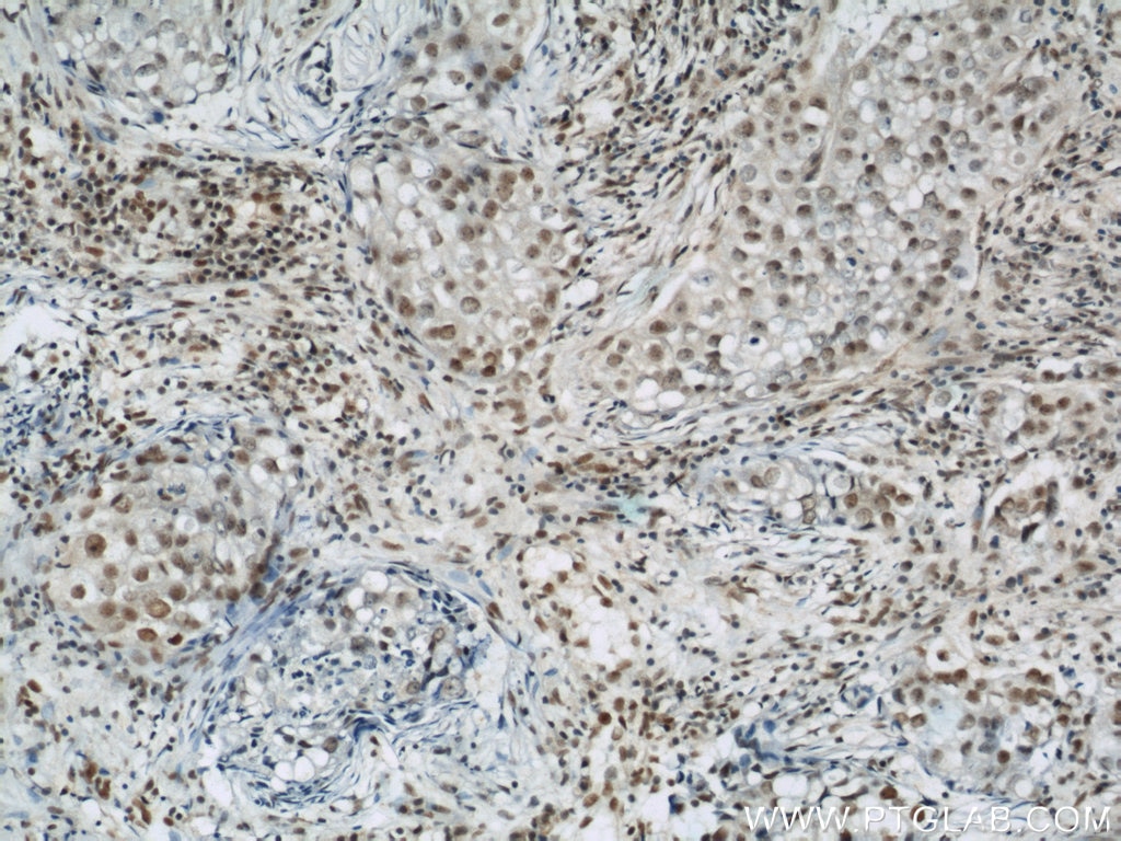 Immunohistochemistry (IHC) staining of human breast cancer tissue using BCAS2 Polyclonal antibody (10414-1-AP)