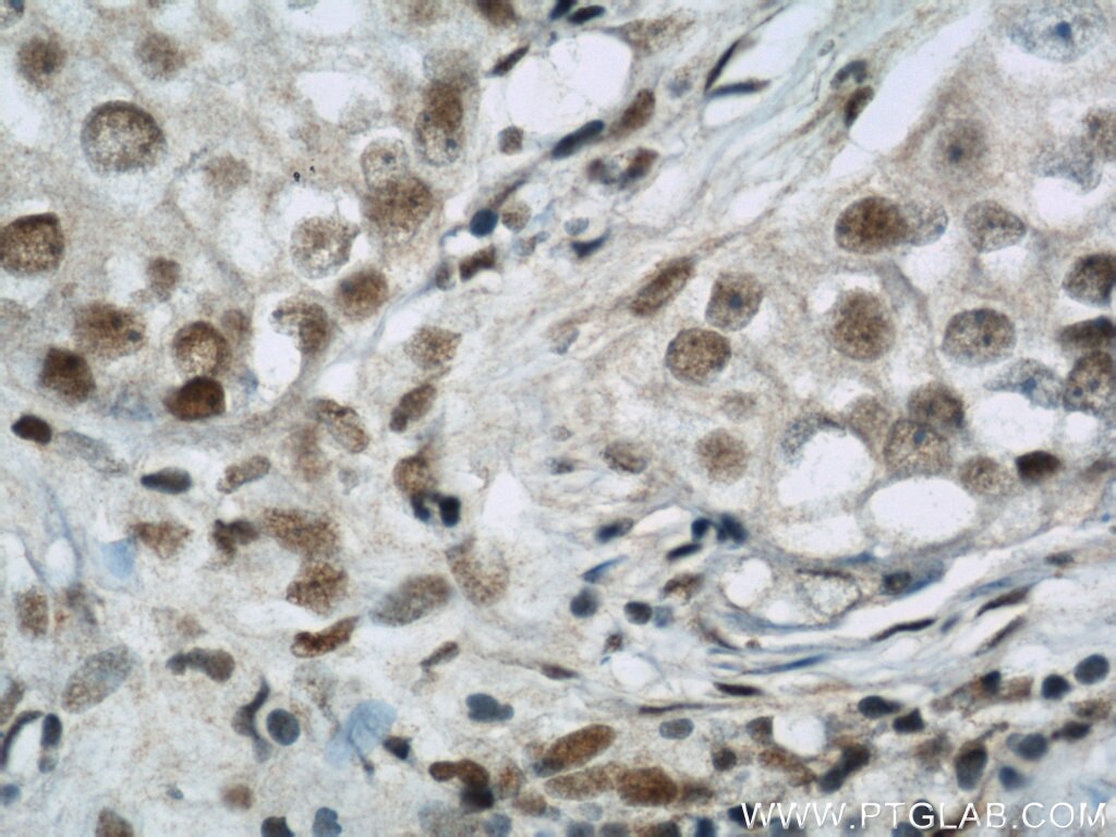 Immunohistochemistry (IHC) staining of human breast cancer tissue using BCAS2 Polyclonal antibody (10414-1-AP)