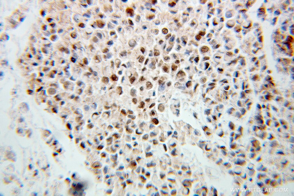 Immunohistochemistry (IHC) staining of human colon cancer tissue using BCAS2 Polyclonal antibody (10414-1-AP)