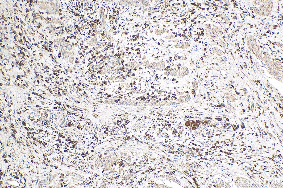 Immunohistochemistry (IHC) staining of human stomach cancer tissue using BCAT1 Polyclonal antibody (13640-1-AP)